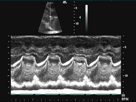 Left Atrial Myxoma M Mode