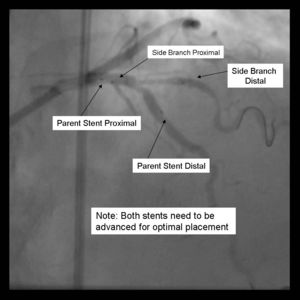 Crush Stenting Step 2