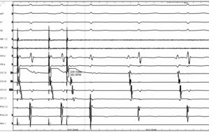 AH interval of 230 ms at Drive train of 400ms and S2 of 230 ms