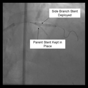 Crush Stenting Step 3