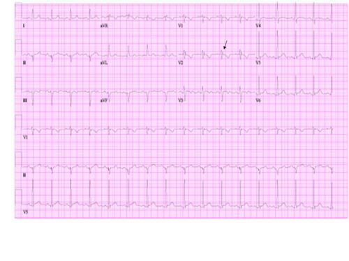 EKG of a patient with ARVD. The Epsilon wave is marked with an arrow.