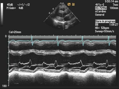 Aortic Regurgitation M Mode