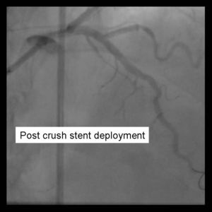 Crush Stenting Step 6