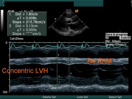 Hypertensive Heart Disease M Mode
