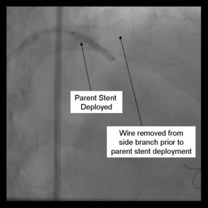 Crush Stenting Step 5