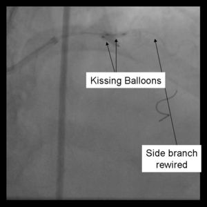 Crush Stenting Step 7