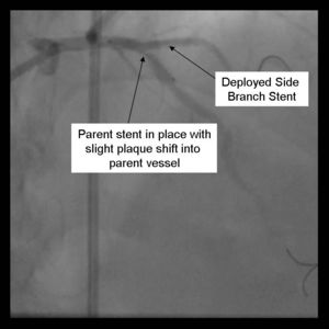 Crush Stenting Step 4