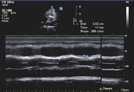 Aortic M-Mode