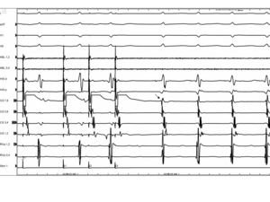 Initiation of AVNRT with double extrastimuli from the CS resulting initiation of a tachycardia with a jump to the slow pathway and concentric retrograde activation. The earliest atrial activation is marked with an arrow